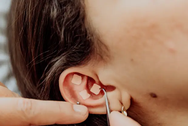 treehouse-acupuncture-on-ears