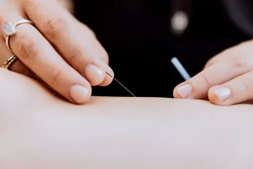 acupuncture closeup