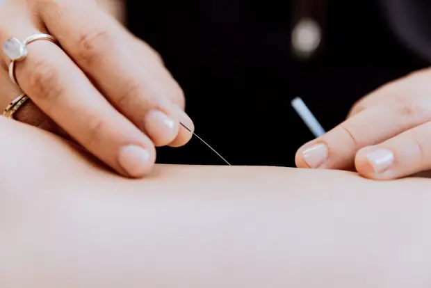 acupuncture service