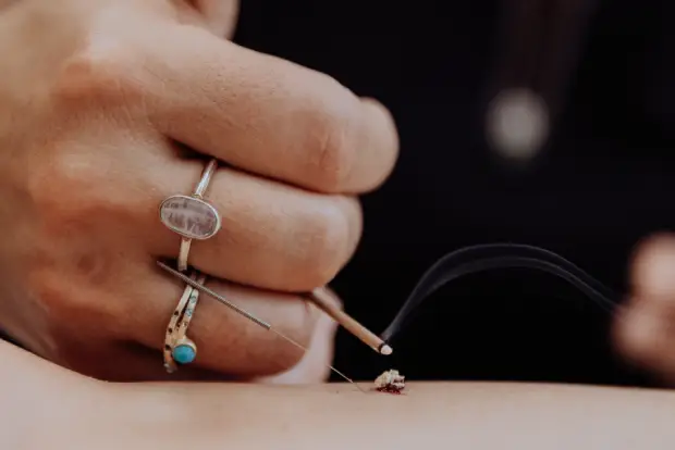 okyupinchcmc accupuncture
